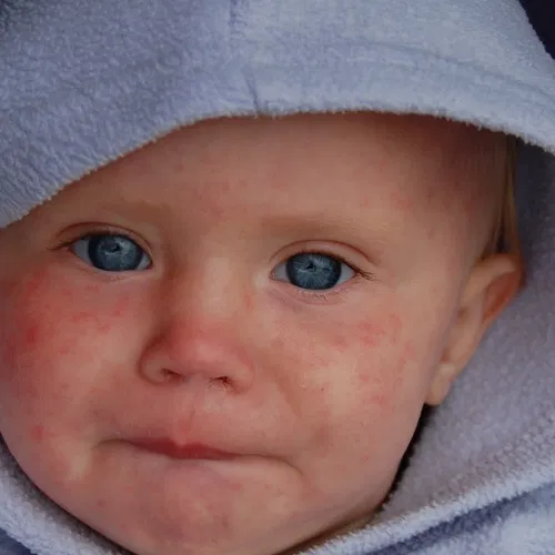 Mazelenuitbraak in Brabant, merendeel ongevaccineerde kinderen