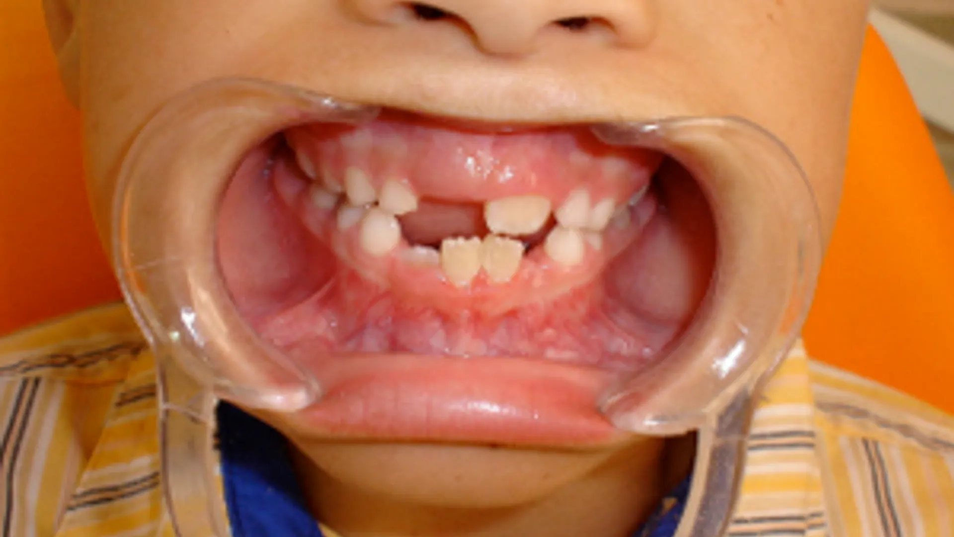 flickr_tandarts_kind_DavidRojo_300