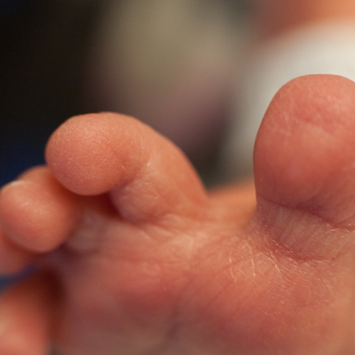 Afbeelding van Antivax-ouders weigeren baby levensreddende operatie wegens bezwaar tegen donorbloed van gevaccineerden